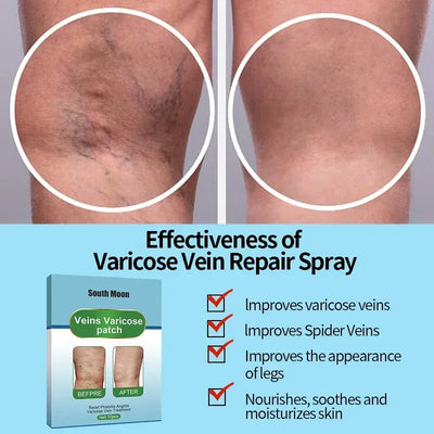 Varicose Veins Relief Patch Foot Care Vasculitis Phlebitis Treatment Cream Spider Leg Varicosity Angiitis Legs Dilated Medicine